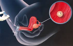 Image result for Intrauterine Insemination