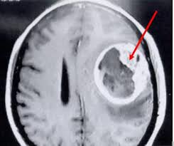 Resultado de imagen para tumores cerebrales