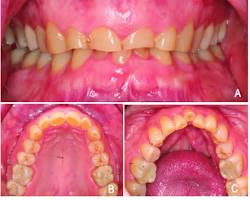 Image of patient with a severely worndown dentition