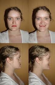 Image result for jaw surgery