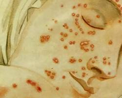 Image of smallpox symptoms historical