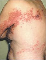 Image result for "Herpes Zoster"