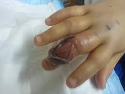 Résultat de recherche d'images pour "copperhead bites"