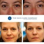 Eye Bags Treatment Worth it? Reviews, Cost, Pictures - RealSelf