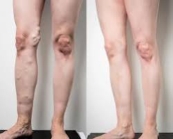 Image of Varicose veins before treatment