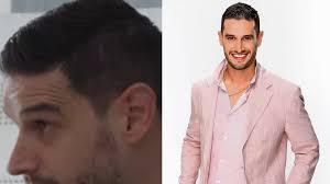 Adrián Marcelo preocupa por extraño hundimiento en el rostro durante entrevista con Ricardo Peralta, ¿es un t