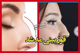 قوز بینی ترند زیبایی ۲۰۲۶ شد +عکس
