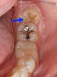 Dents de sagesse, Avant, Pendant et Aprs l Extraction