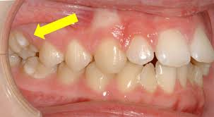 Image result for tonsilith