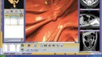 CAD for Colon Makes its Debut