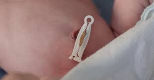 Potential Benefits and Safety of Umbilical Cord Milking for Preterm Infants Born after 28 Weeks