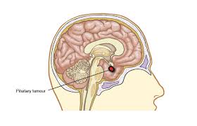images?q=tbn:ANd9GcQlipIUK5vII LmbXsexBgiaauU9RfQD0gfHy d HseSLN X0bH - Лечение аденомы гипофиза в Израиле