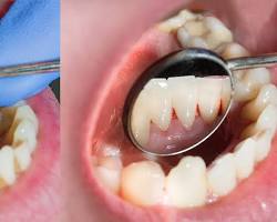 Image of Healthy teeth vs. teeth with tartar