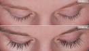 Eyelash Growth from Application of Bimatoprost in Gel Suspension
