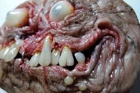 Image result for teratoma