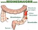 Inflammation du colon que manger