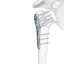 Johnson & Johnson Launches VOLT™ Wrist and Proximal Humerus ...