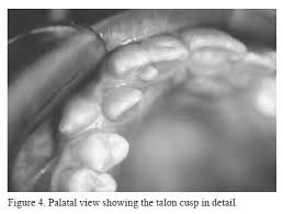 Résultat de recherche d'images pour "shovel shaped incisors"