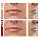 Los Angeles Injectables Fillers - Deals in Los Angeles, CA Groupon