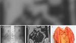  Surgical sponges left inside woman for at least 6 years