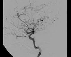 뇌혈관 조영술 이미지