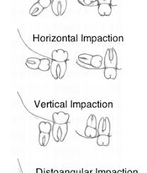 wisdom teeth via Relatably.com