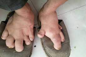 Image result for Filariasis / Penyakit Kaki Gajah