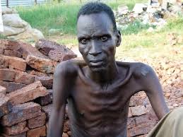Image result for images of tuberculosis patients