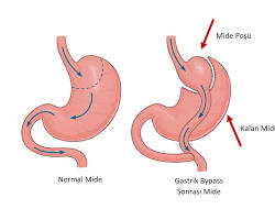 Gastrik bypass ameliyatı