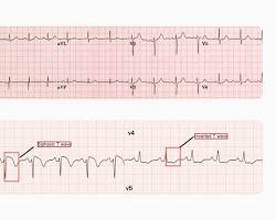 normal ECG and an irregular ECGの画像