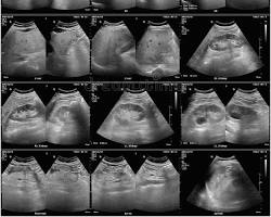 ultrasound image showing the liver, gallbladder, pancreas, and kidneysの画像