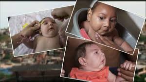 Image result for pictures of zika babies