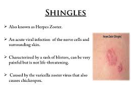 Image result for "Herpes Zoster"