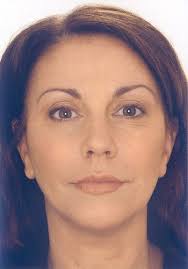 Botox am Bodensee, Dr. <b>Joachim Jakob</b> Senger - Facharzt für Allgemeinmedizin <b>...</b> - frau_nachher_350x501