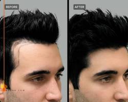 Image of نتائج زراعة الشعر قبل وبعد في عيادات الرياض للرجال والنساء hair transplant results before and after Riyadh clinics