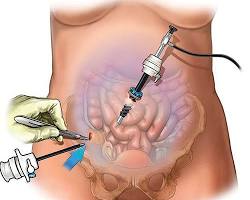 La chirurgia è il pilastro fondamentale del trattamento del cancro dell'ovaio. L'intervento chirurgico ha lo scopo di rimuovere il tumore e valutare l'estensione della malattia.