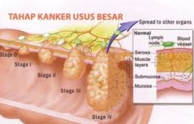 Image result for kanker