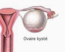 Kystes ovariens