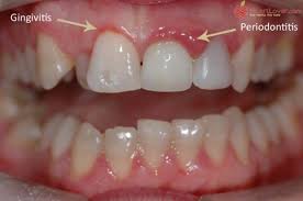 Remedies to Reduce Gum Swelling