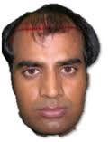 Dr.Bishan Mahadevia&#39;s – Hair Loss Specialist | Hair Doctor | Hair Surgeon - Goodbyehairloss - 2a