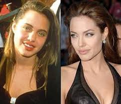 Resultado de imagem para before after surgery