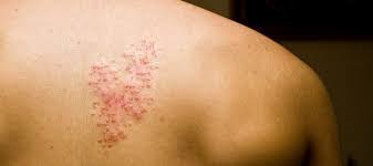 Image result for "Herpes Zoster"