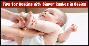 Image result for newborn diaper rash