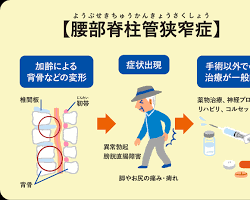 脊柱管狭窄症の治療方法の画像