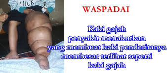 Image result for Filariasis / Penyakit Kaki Gajah