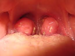 Image result for tonsilith