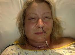 Rachel Parsons after her nine-hour mouth cancer operation in 2008. “We nicknamed each of my scars to try to explain to the children what was happening to me ... - JS29107650