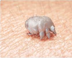 Scabies Mites