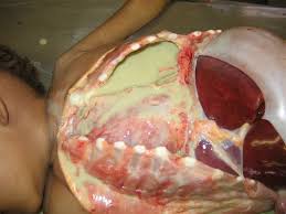 Image result for images of empyema
