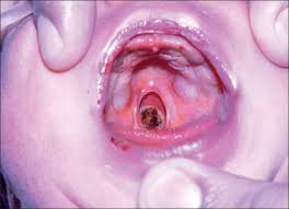 Image result for teratoma